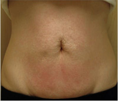 VelaShape Before & After Gallery - Patient 123388 - Image 2