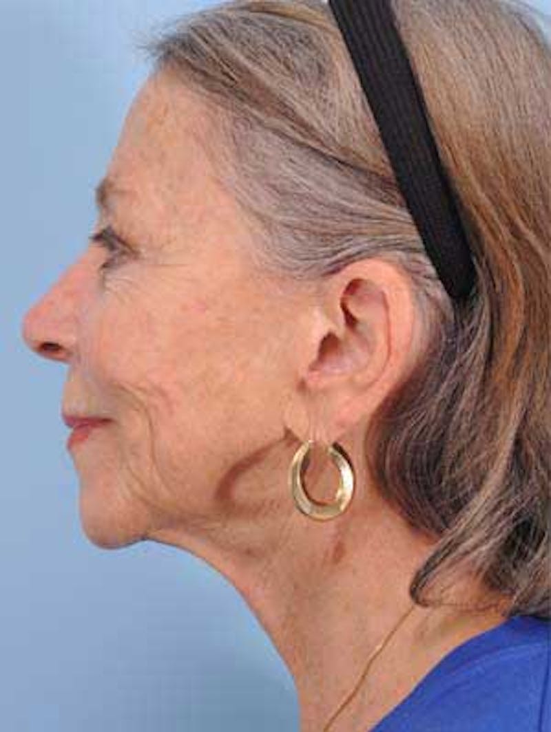 Facial Resurfacing Before & After Gallery - Patient 118091 - Image 3