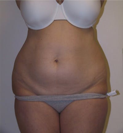 Ultrashape Before & After Gallery - Patient 308500 - Image 1