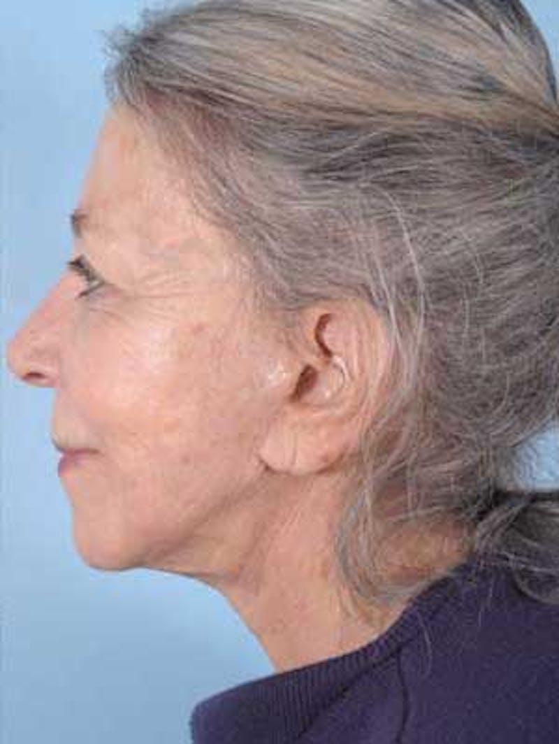 Facial Resurfacing Before & After Gallery - Patient 118091 - Image 4