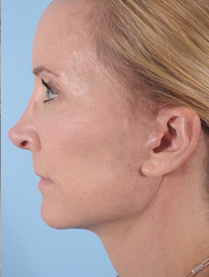 Facelift Before & After Gallery - Patient 472008 - Image 4