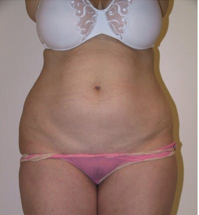Ultrashape Before & After Gallery - Patient 308500 - Image 2