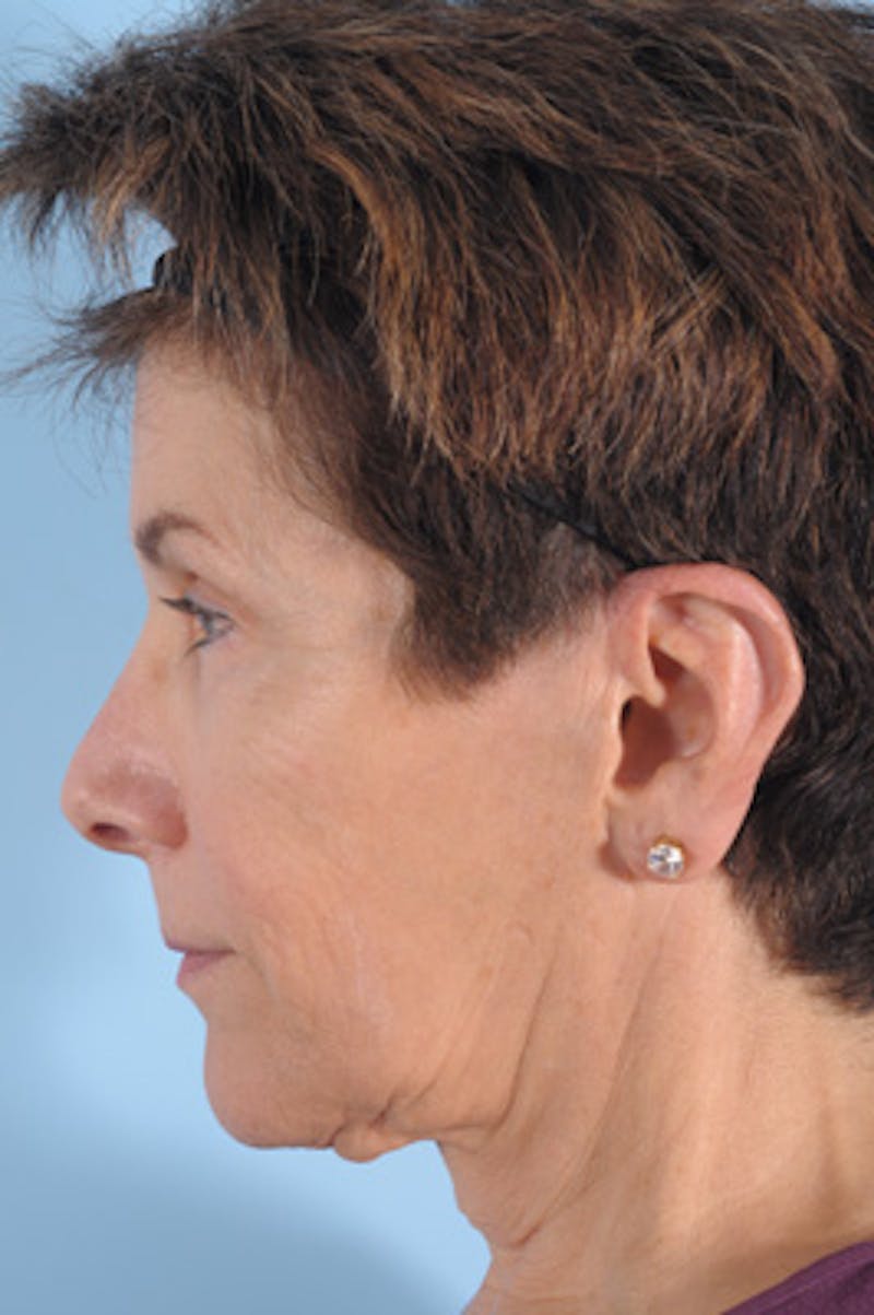 Facelift Before & After Gallery - Patient 651315 - Image 3
