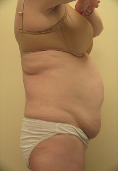 Ultrashape Before & After Gallery - Patient 232262 - Image 1