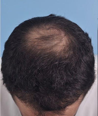Hair Graft Surgery Before & After Gallery - Patient 322960 - Image 1