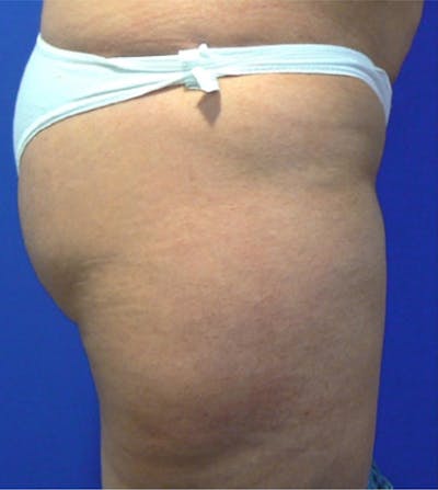 Ultrashape Before & After Gallery - Patient 329771 - Image 1
