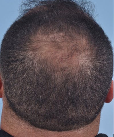 Hair Graft Surgery Before & After Gallery - Patient 414916 - Image 1