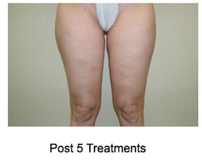 VelaShape Before & After Gallery - Patient 253249 - Image 2