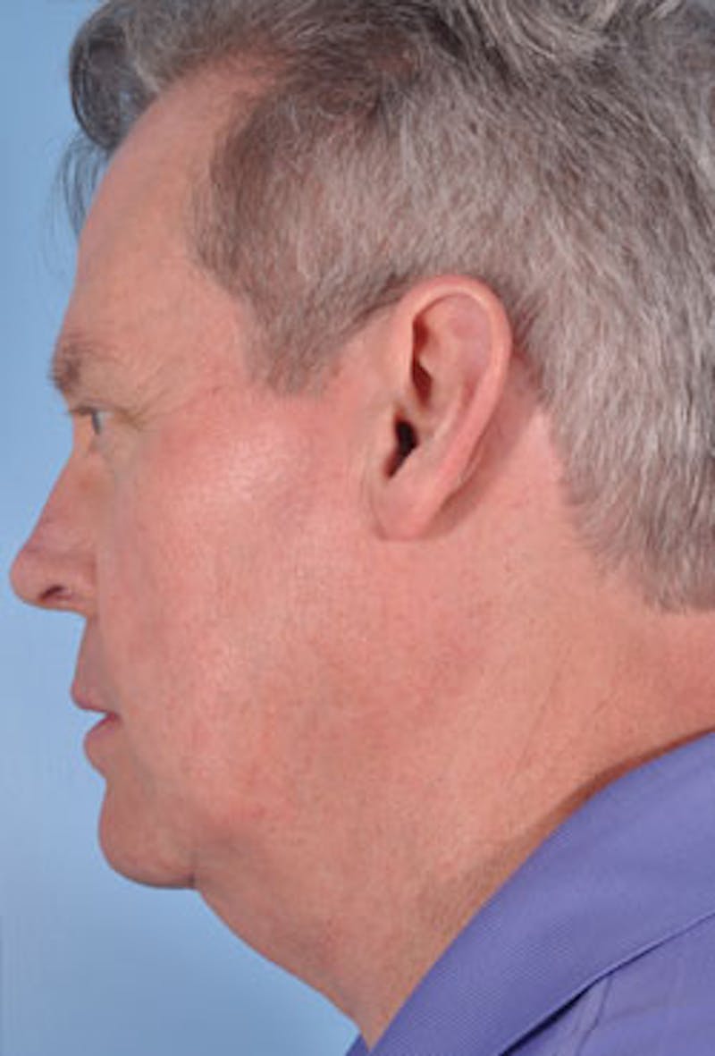 Facelift Before & After Gallery - Patient 926616 - Image 3