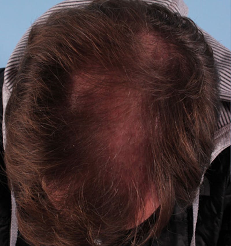 Hair Graft Surgery Before & After Gallery - Patient 381205 - Image 1