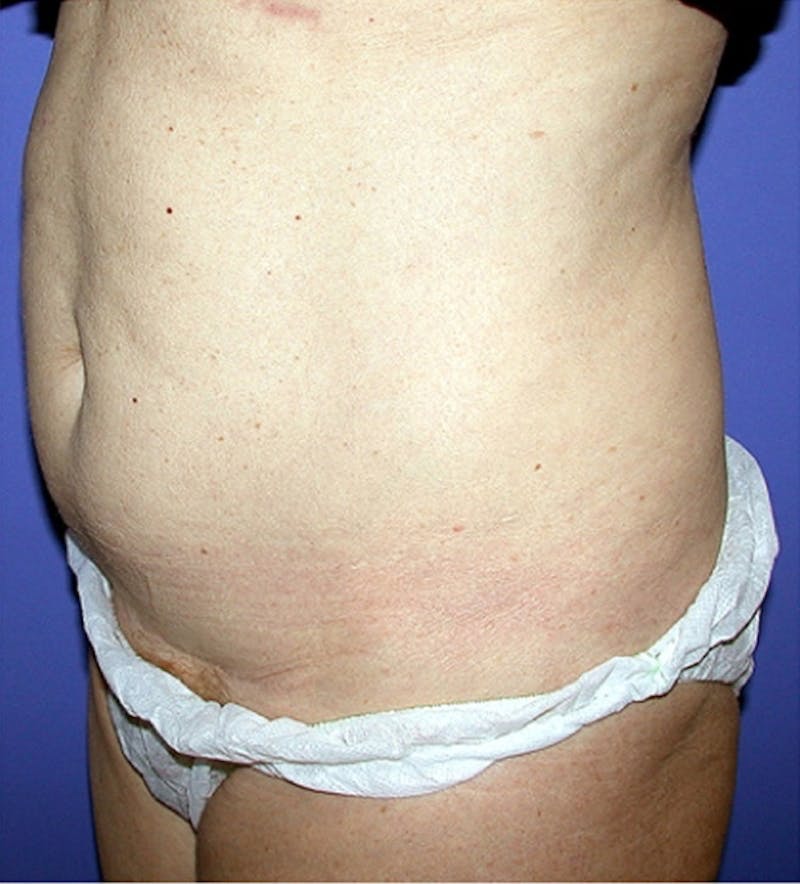 Ultrashape Before & After Gallery - Patient 401179 - Image 1