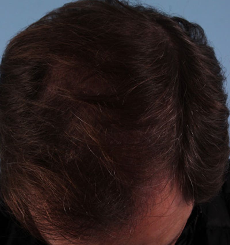 Hair Graft Surgery Before & After Gallery - Patient 381205 - Image 2