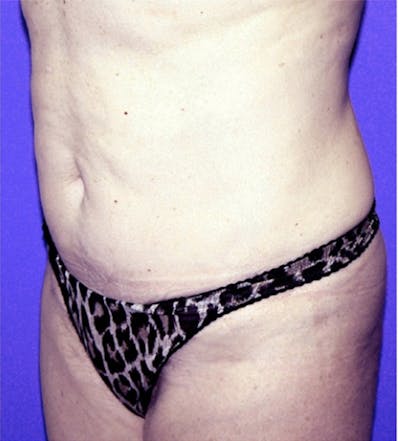 Ultrashape Before & After Gallery - Patient 401179 - Image 2