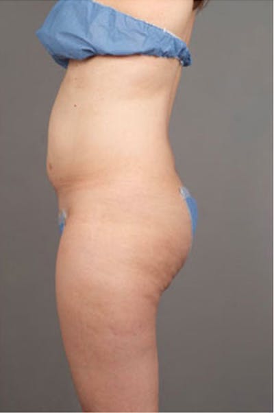 Ultrashape Before & After Gallery - Patient 342253 - Image 1