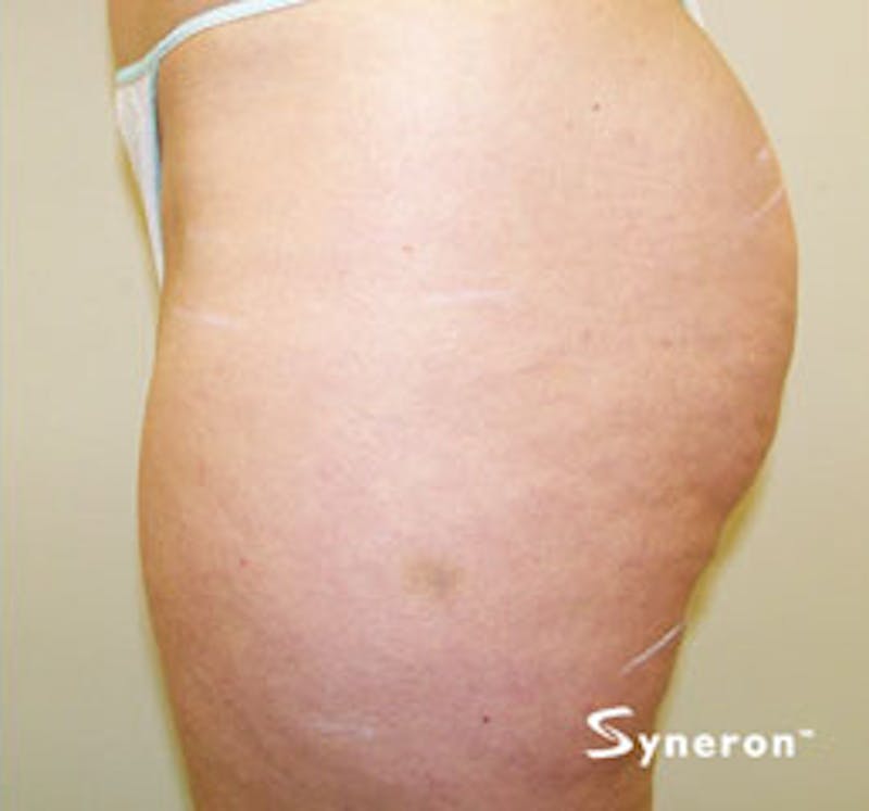 VelaShape Before & After Gallery - Patient 314191 - Image 2