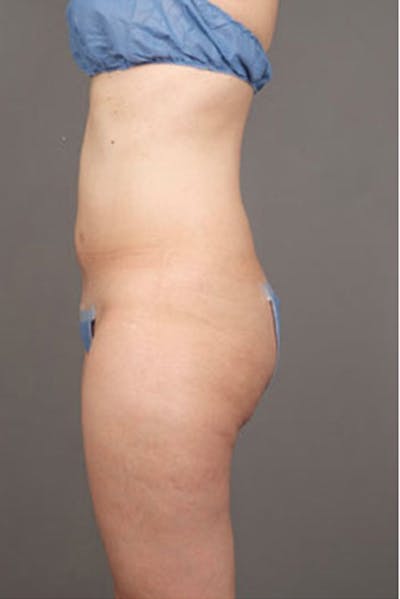 Ultrashape Before & After Gallery - Patient 342253 - Image 2