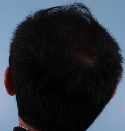 Hair Graft Surgery Before & After Gallery - Patient 373486 - Image 2
