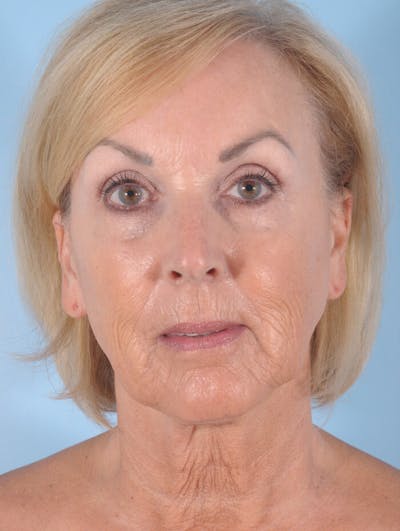 Facelift Before & After Gallery - Patient 314497 - Image 1