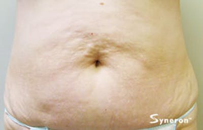 VelaShape Before & After Gallery - Patient 173715 - Image 1