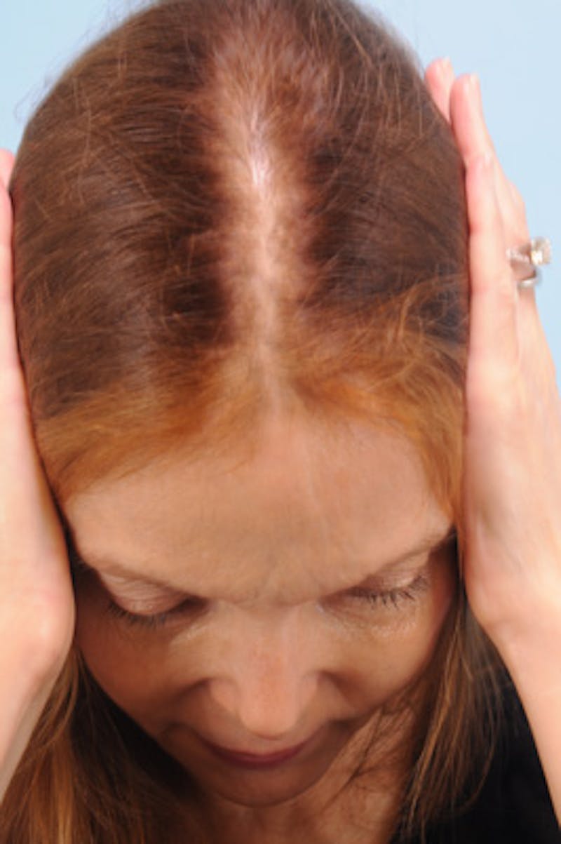Hair Graft Surgery Before & After Gallery - Patient 270839 - Image 1
