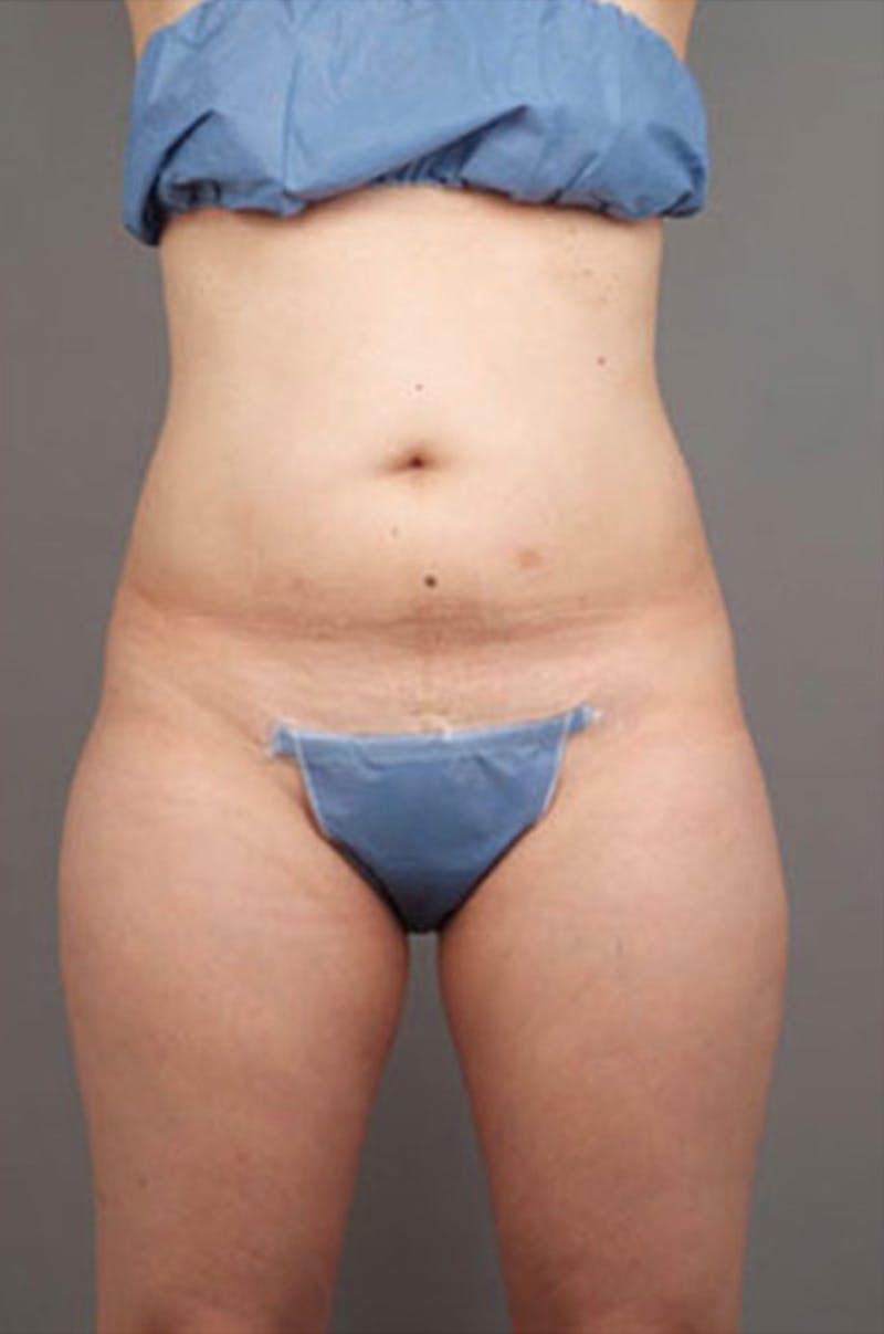 Ultrashape Before & After Gallery - Patient 342253 - Image 5