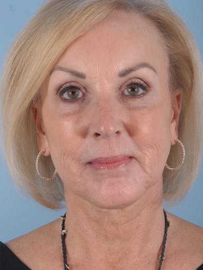 Facelift Before & After Gallery - Patient 314497 - Image 2