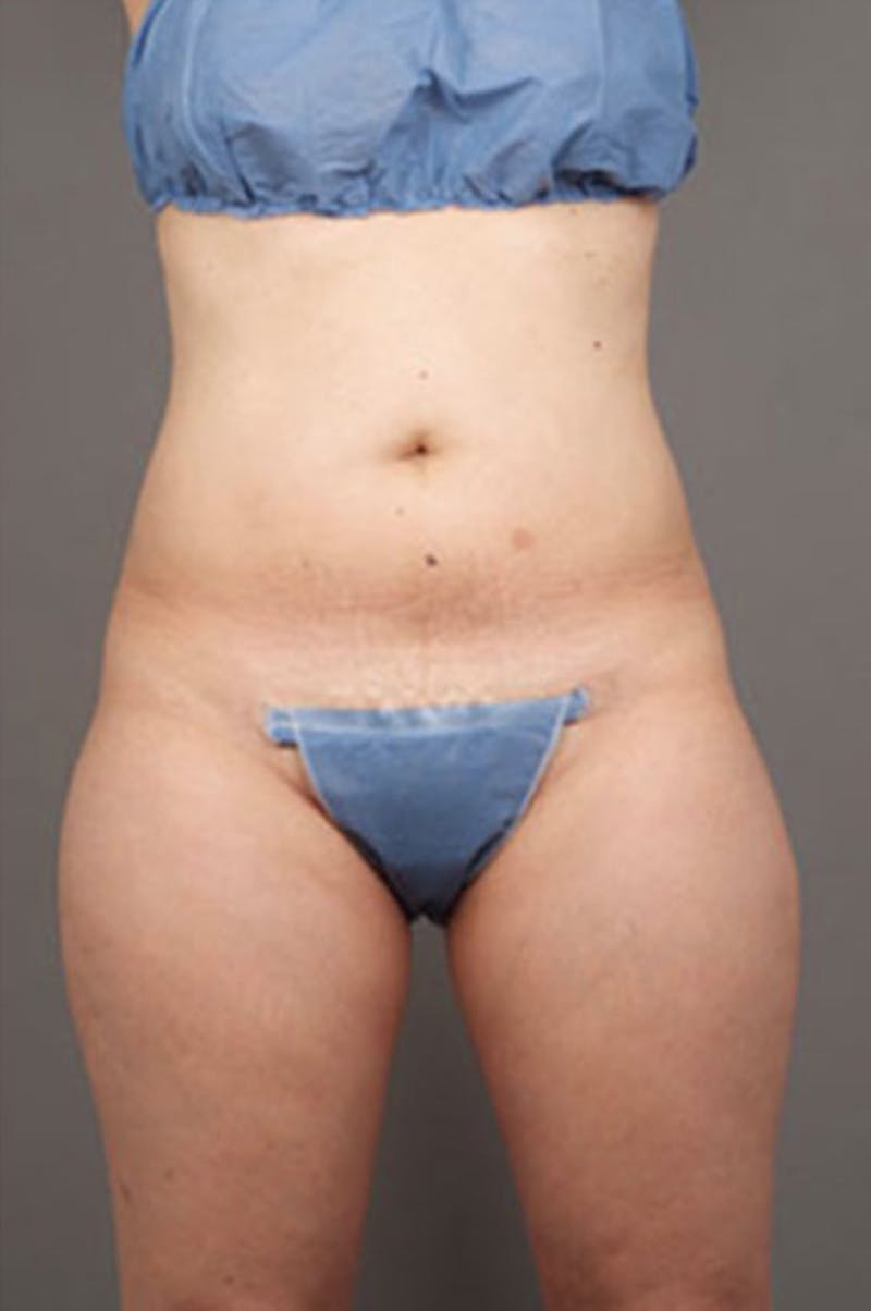 Ultrashape Before & After Gallery - Patient 342253 - Image 6