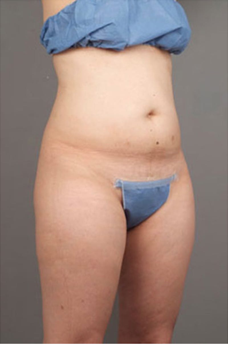 Ultrashape Before & After Gallery - Patient 342253 - Image 7