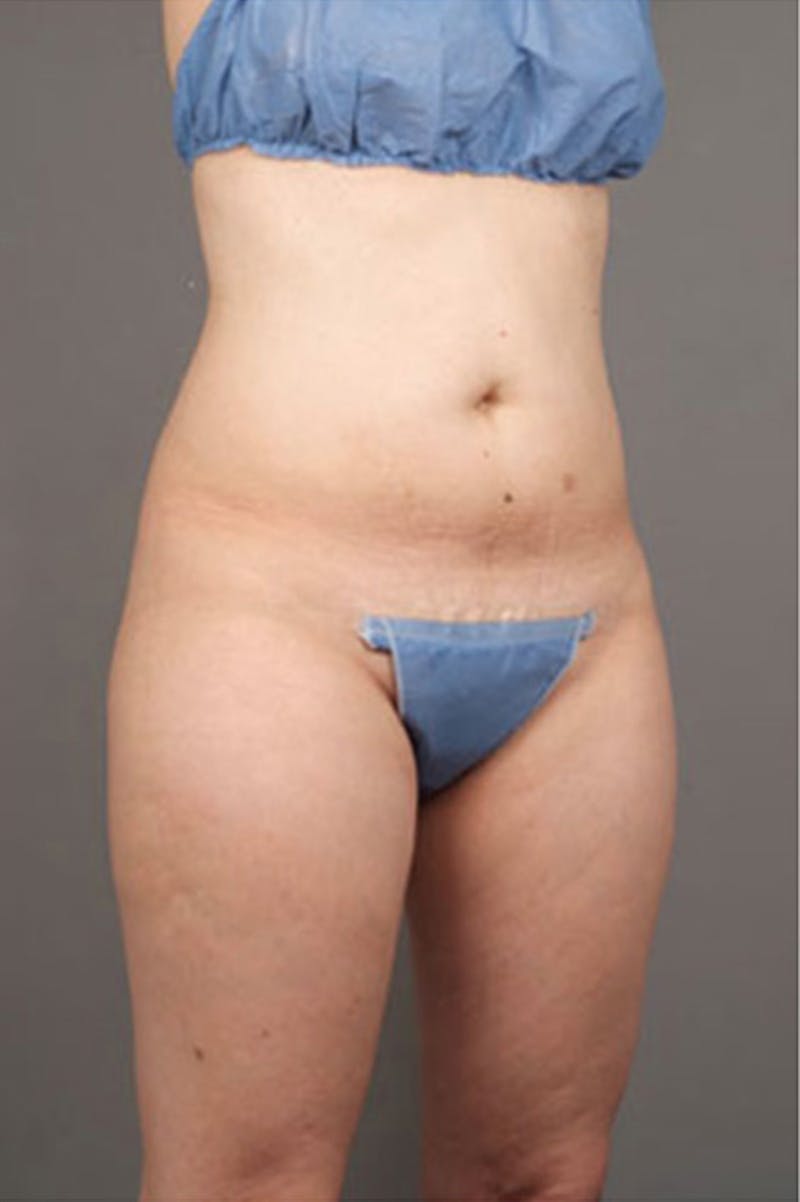 Ultrashape Before & After Gallery - Patient 342253 - Image 8