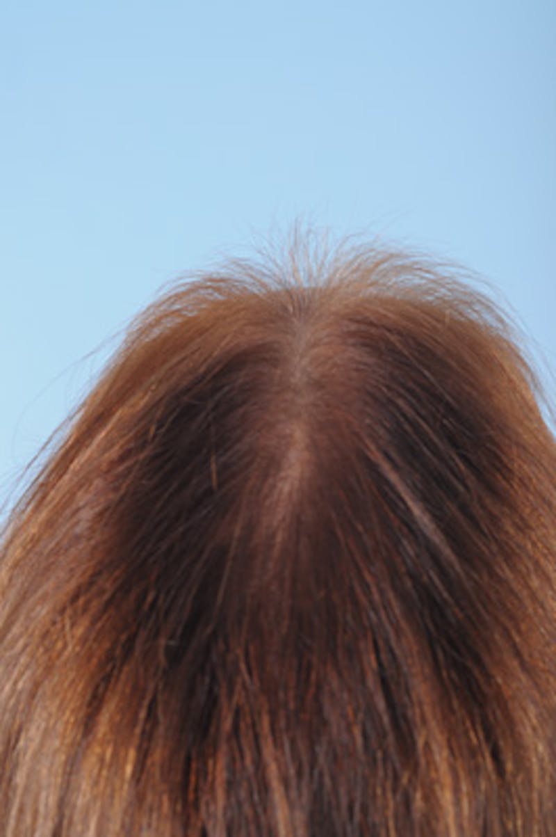 Hair Graft Surgery Before & After Gallery - Patient 270839 - Image 6