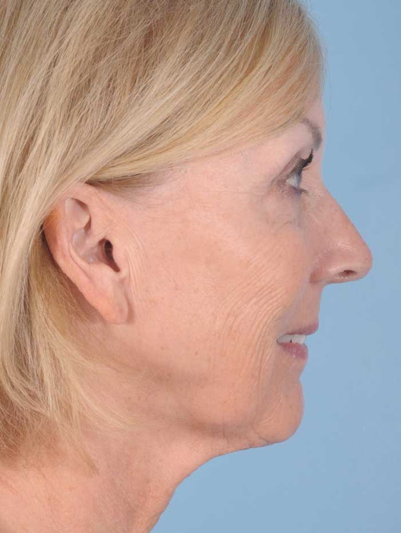 Fat Transfer Before & After Gallery - Patient 114500 - Image 3
