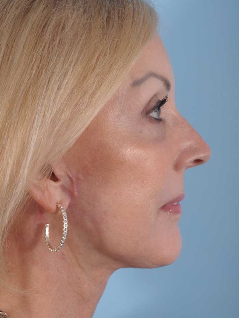 Fat Transfer Before & After Gallery - Patient 114500 - Image 4
