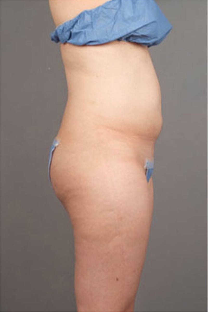 Ultrashape Before & After Gallery - Patient 342253 - Image 9