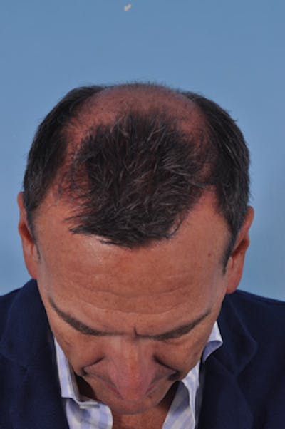 Hair Graft Surgery Before & After Gallery - Patient 129536 - Image 1