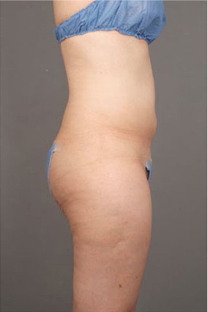 Ultrashape Before & After Gallery - Patient 342253 - Image 10