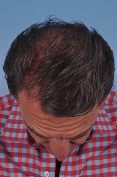 Hair Graft Surgery Before & After Gallery - Patient 129536 - Image 2