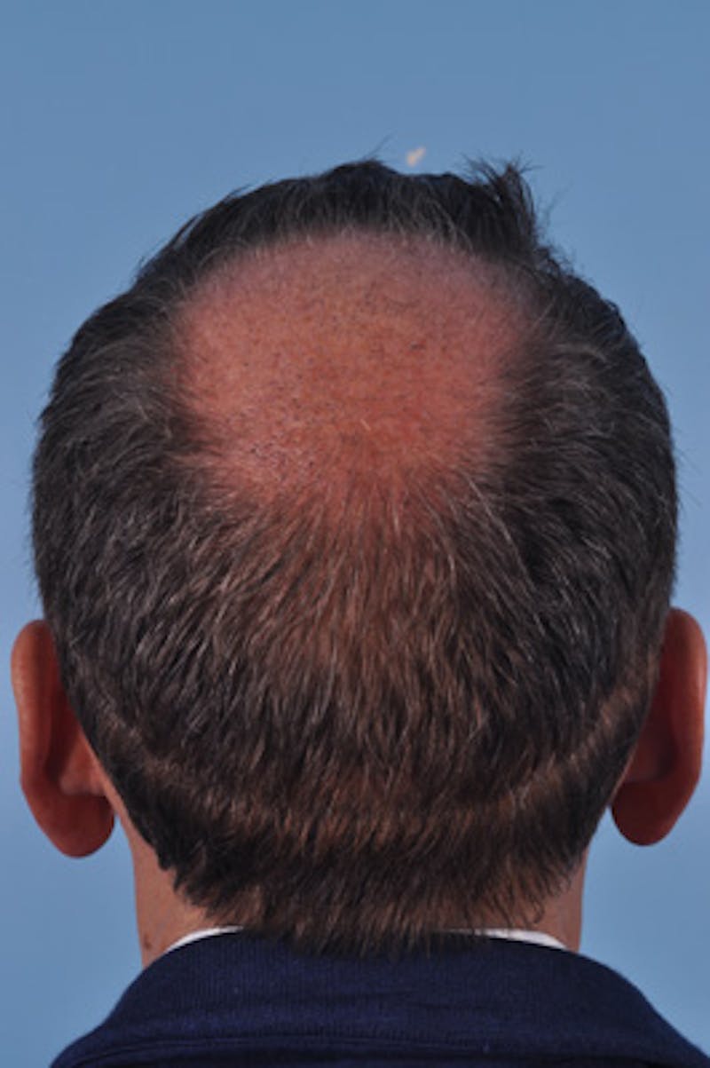 Hair Graft Surgery Before & After Gallery - Patient 129536 - Image 3