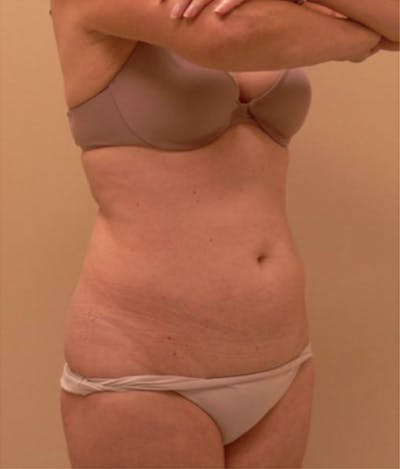 Ultrashape Before & After Gallery - Patient 348038 - Image 2