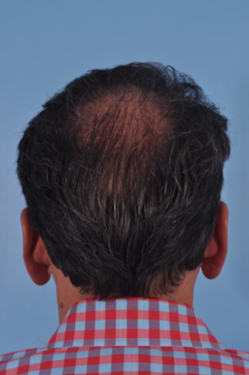 Hair Graft Surgery Before & After Gallery - Patient 129536 - Image 4