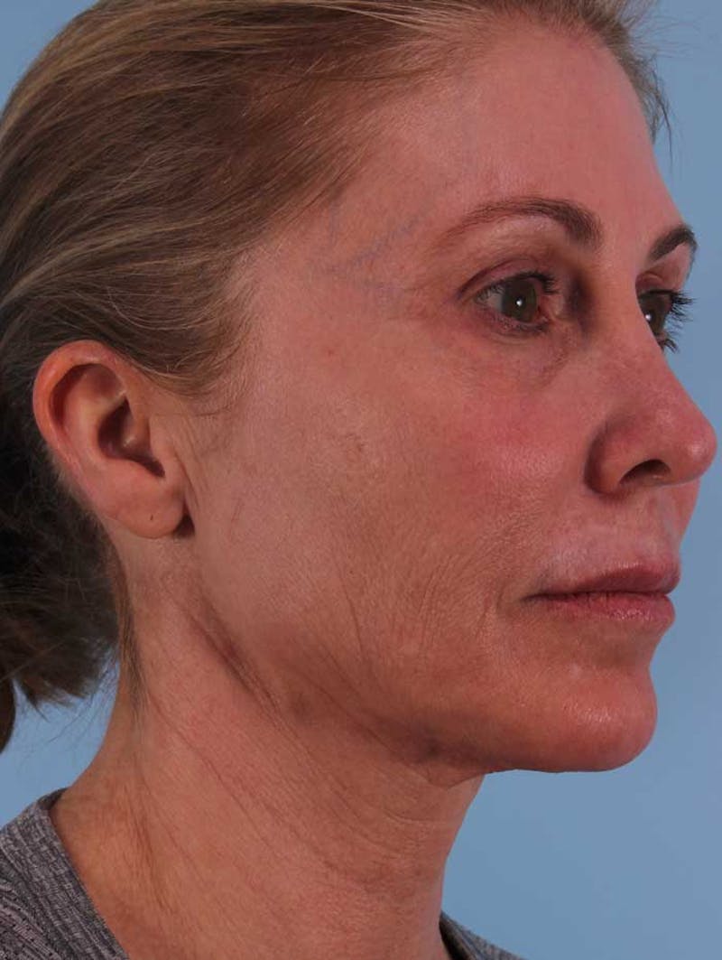 Fat Transfer Before & After Gallery - Patient 393766 - Image 3