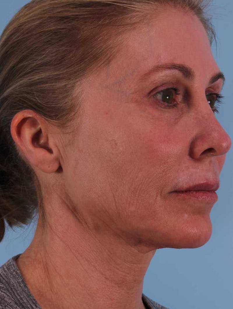 Facelift Before & After Gallery - Patient 255936 - Image 3