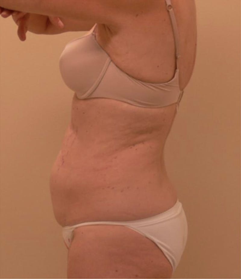 Ultrashape Before & After Gallery - Patient 348038 - Image 3
