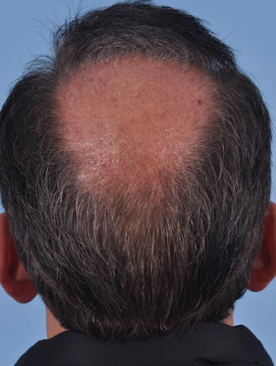 Hair Graft Surgery Before & After Gallery - Patient 150856 - Image 1