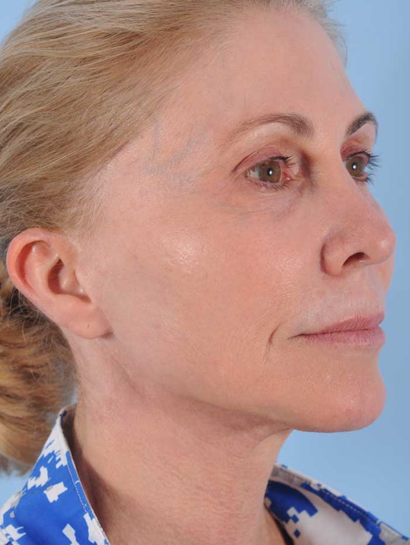 Facelift Before & After Gallery - Patient 255936 - Image 4