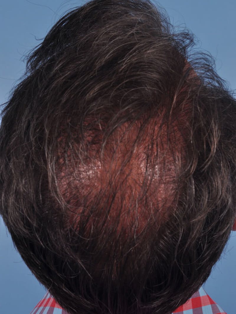 Hair Graft Surgery Before & After Gallery - Patient 150856 - Image 2