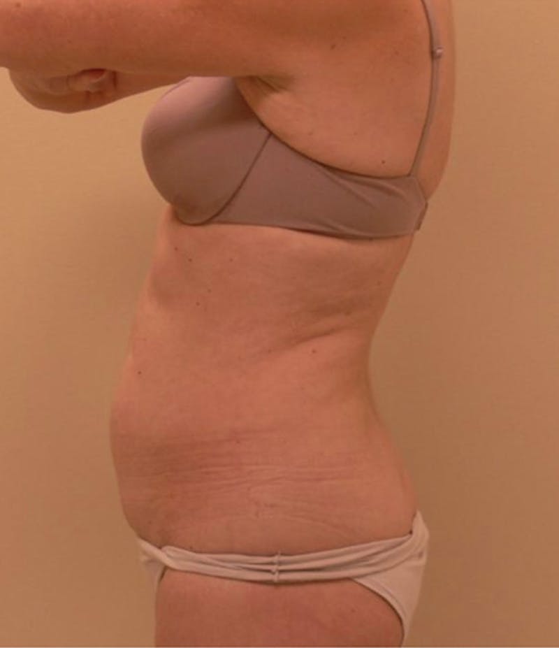 Ultrashape Before & After Gallery - Patient 348038 - Image 4