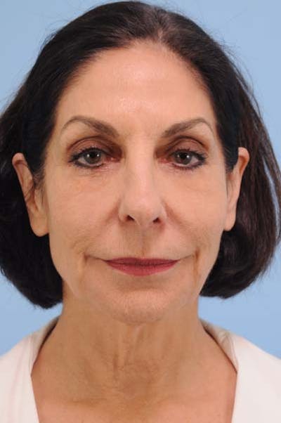 Facelift Surgery  Before & After Gallery - Patient 110505 - Image 1