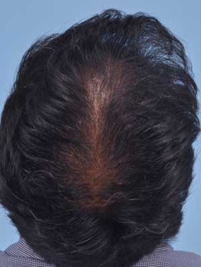 Hair Graft Surgery Before & After Gallery - Patient 239122 - Image 1