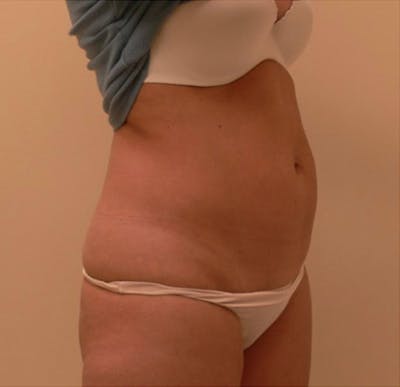 Ultrashape Before & After Gallery - Patient 339058 - Image 1