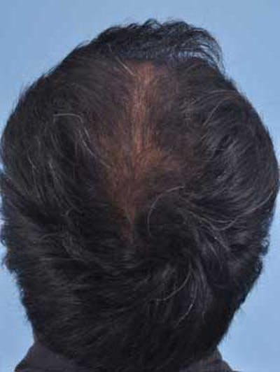 Hair Graft Surgery Before & After Gallery - Patient 239122 - Image 2